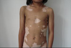 儿童白癜风：儿童白癜风有哪些常见的诊断方法
